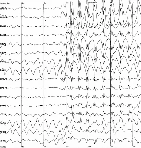 EEG readout of a seizure
