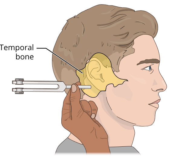 An illustration of a person’s right-facing profile with a tuning fork stem placed on the temporal bone. The tuning fork is held horizontally by the stem and placed so the stem is behind and beneath the external ear. The temporal bone is labeled and highlighted.