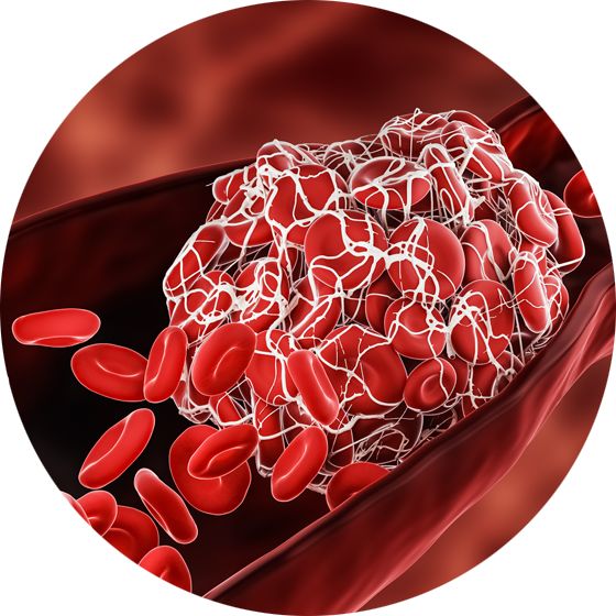 Blood Clot | Stroke Research