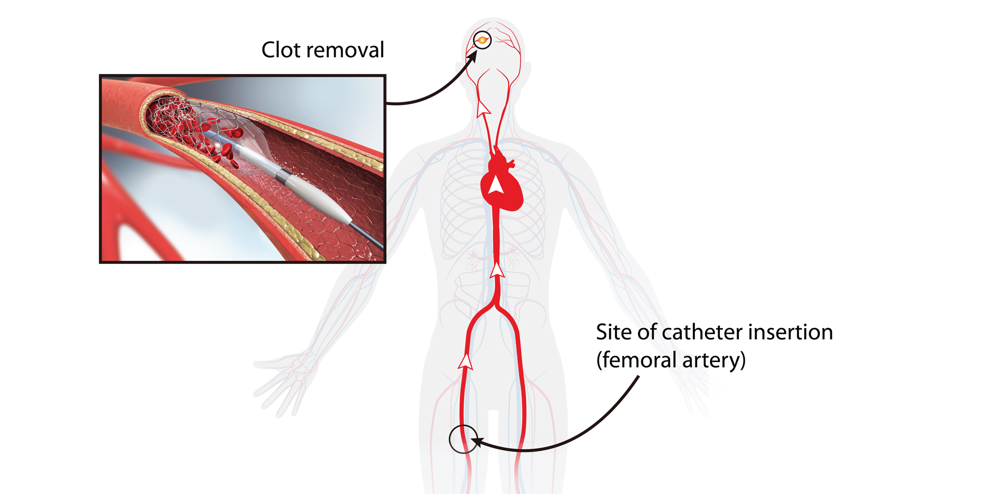 Endovascular Thrombectomy