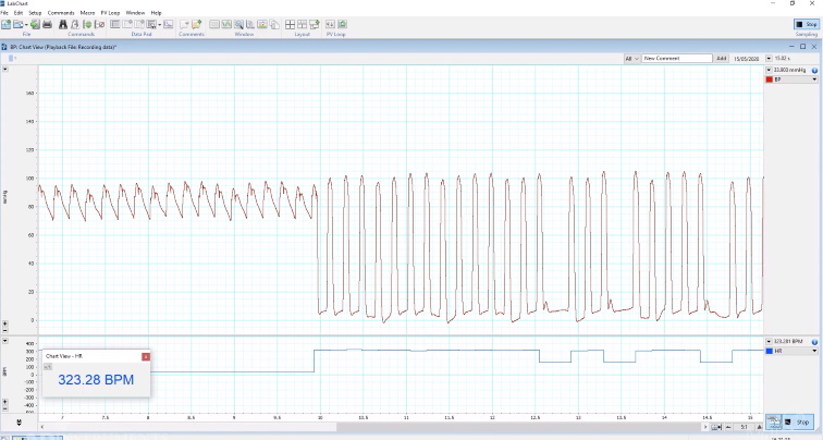 LV Pressure systemic to ventricular signal | Research | ADI