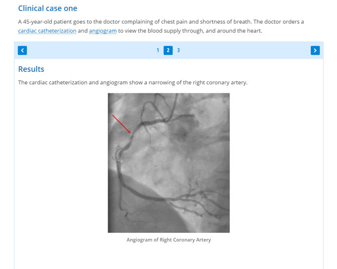Angiogram of right coronary artery