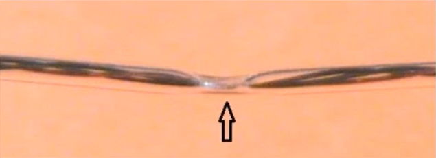 Millar catheter squashed by forceps