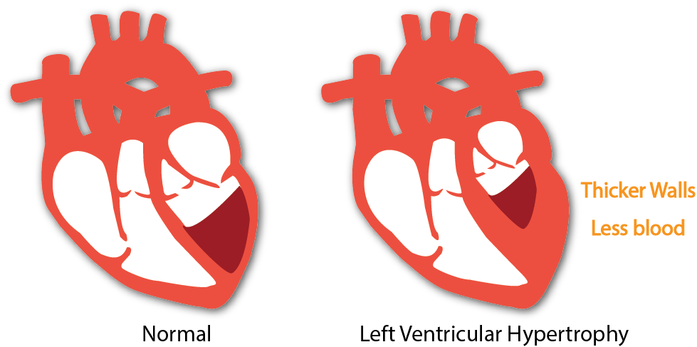 Left ventricular hypertrophy stylized image
