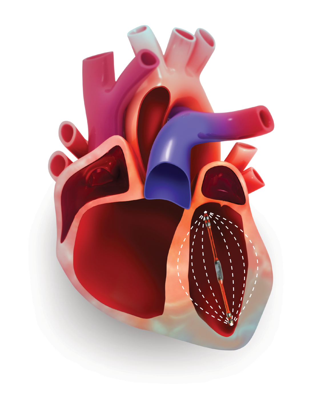 Pressure-Volume (PV) Catheter in Heart