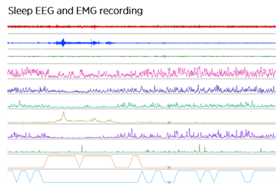 Sleep EEG and EMG recording